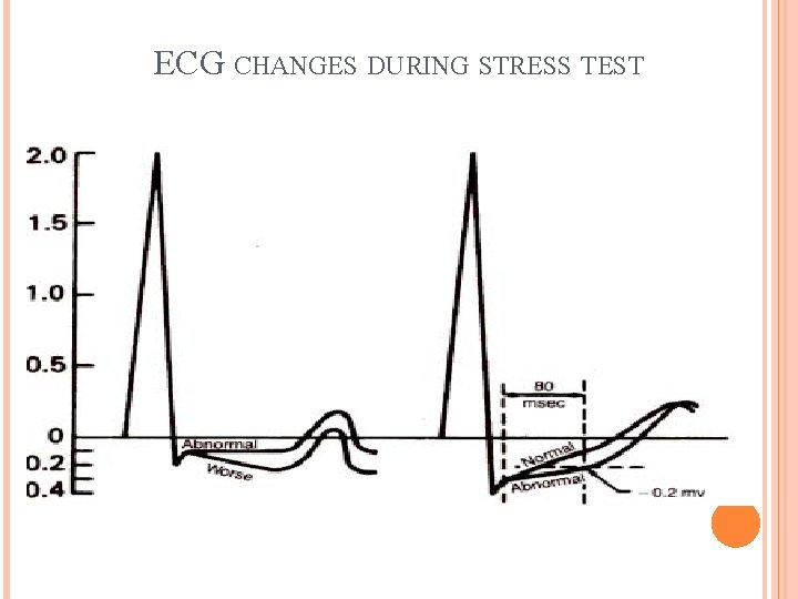 ECG CHANGES DURING STRESS TEST 