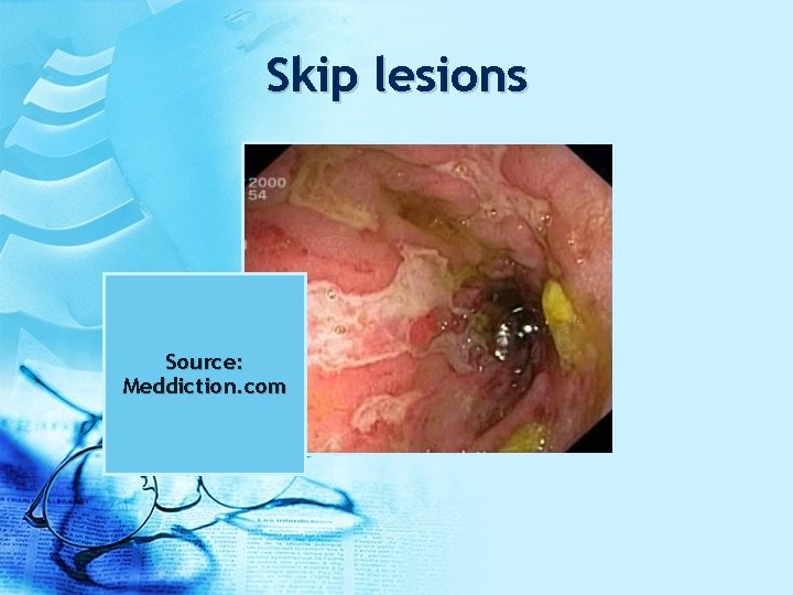 Skip lesions Source: Meddiction. com 