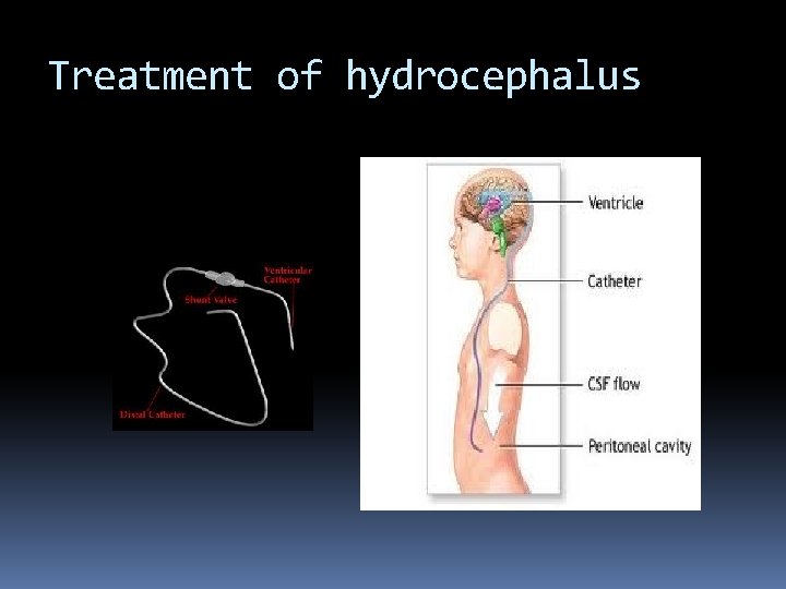 Treatment of hydrocephalus 