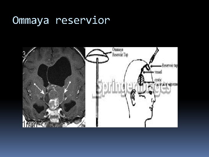 Ommaya reservior 