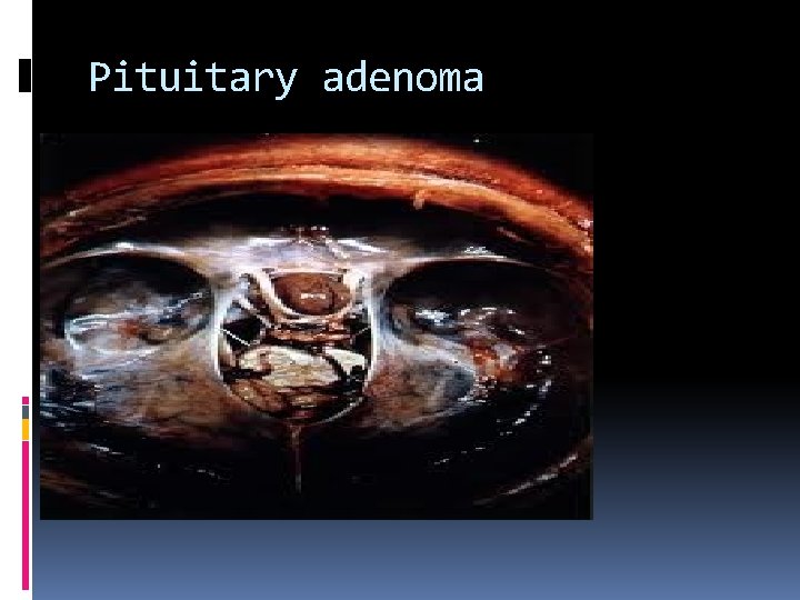 Pituitary adenoma 