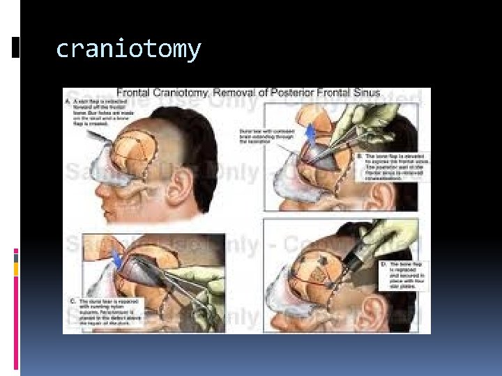 craniotomy 