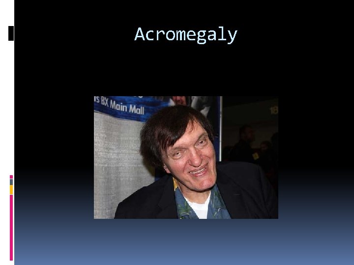 Acromegaly 