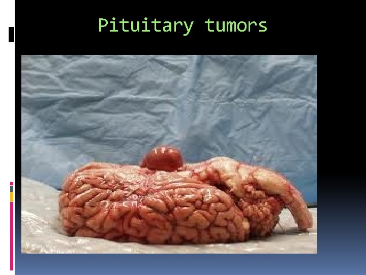 Pituitary tumors 