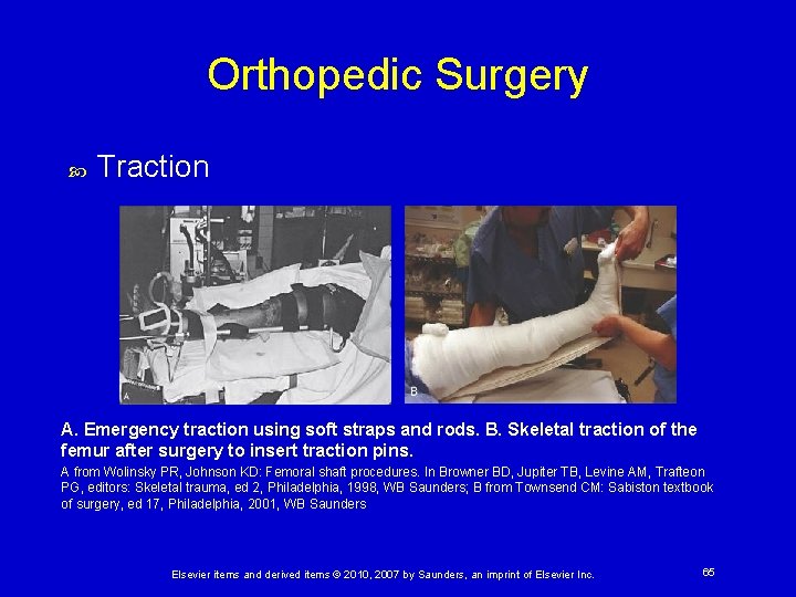 Orthopedic Surgery Traction A. Emergency traction using soft straps and rods. B. Skeletal traction
