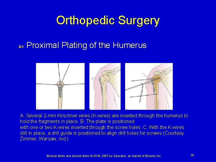 Orthopedic Surgery Proximal Plating of the Humerus A. Several 2 -mm Kirschner wires (K-wires)