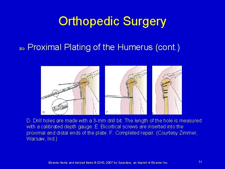 Orthopedic Surgery Proximal Plating of the Humerus (cont. ) D. Drill holes are made