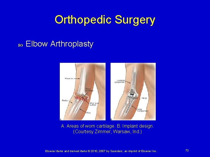 Orthopedic Surgery Elbow Arthroplasty A. Areas of worn cartilage. B. Implant design. (Courtesy Zimmer,