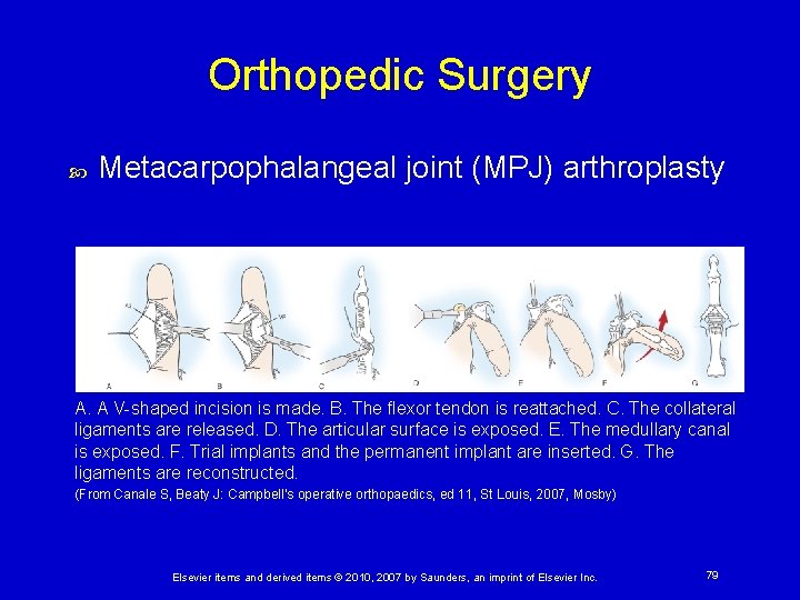 Orthopedic Surgery Metacarpophalangeal joint (MPJ) arthroplasty A. A V-shaped incision is made. B. The