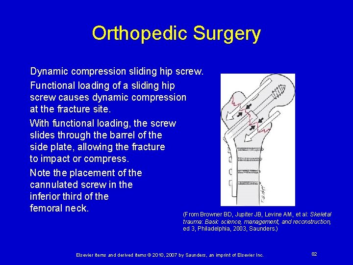 Orthopedic Surgery Dynamic compression sliding hip screw. Functional loading of a sliding hip screw