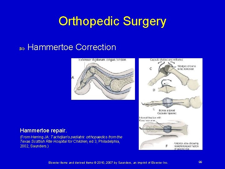 Orthopedic Surgery Hammertoe Correction Hammertoe repair. (From Herring JA: Tachdjian's pediatric orthopaedics from the
