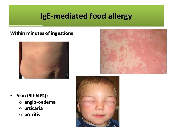 Ig. E-mediated food allergy Within minutes of ingestions • Anaplyhlaxis o skin and mucosa