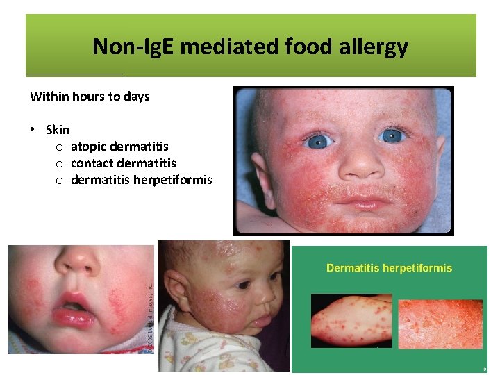 Non-Ig. E mediated food allergy Within hours to days • Skin o atopic dermatitis