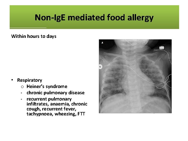 Non-Ig. E mediated food allergy Within hours to days • Skin o atopic dermatitis
