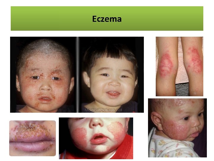 Eczema 