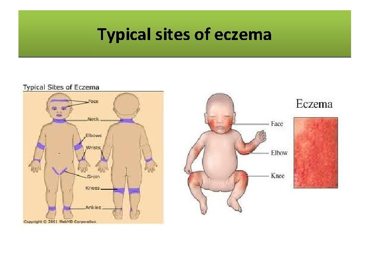 Typical sites eczema Common Sitesofof Eczema 