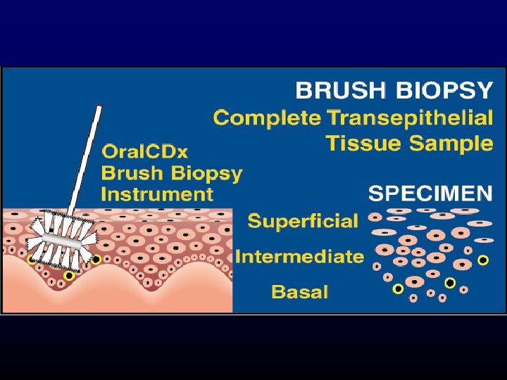 Prevention and Early Detection of Oral Cancer For