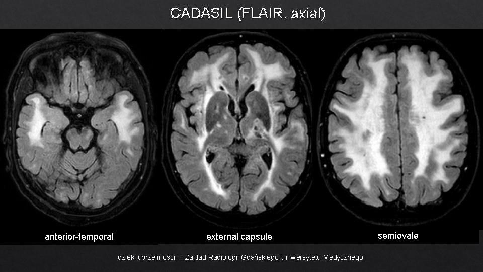 CADASIL (FLAIR, axial) anterior-temporal external capsule dzięki uprzejmości: II Zakład Radiologii Gdańskiego Uniwersytetu Medycznego