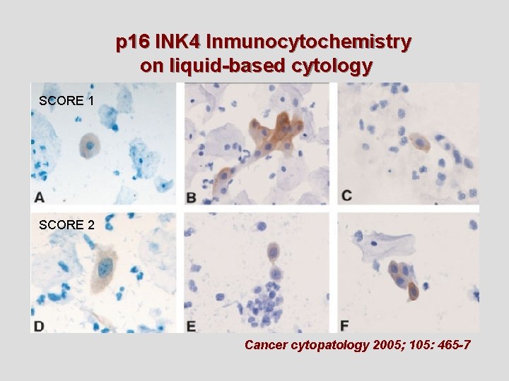 p 16 INK 4 Inmunocytochemistry on liquid-based cytology SCORE 1 SCORE 2 Cancer cytopatology