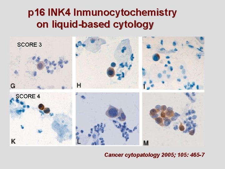 p 16 INK 4 Inmunocytochemistry on liquid-based cytology SCORE 3 SCORE 4 Cancer cytopatology