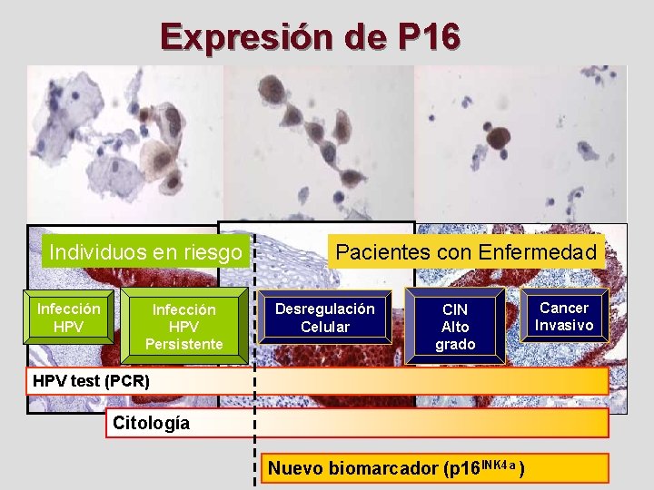 Expresión de P 16 Individuos en riesgo Infección HPV Persistente Pacientes con Enfermedad Desregulación