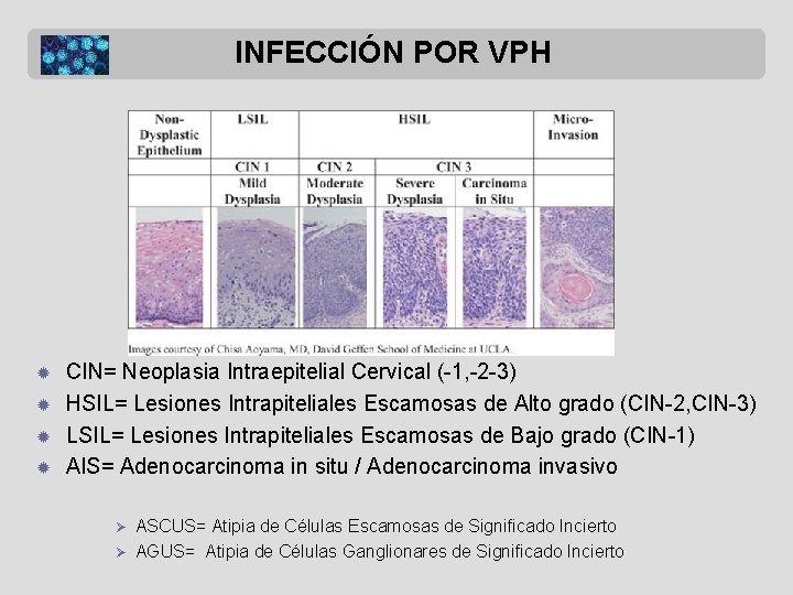 INFECCIÓN POR VPH ® ® CIN= Neoplasia Intraepitelial Cervical (-1, -2 -3) HSIL= Lesiones