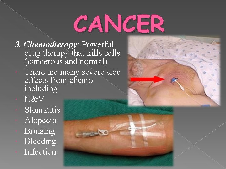 CANCER 3. Chemotherapy: Powerful drug therapy that kills cells (cancerous and normal). There are