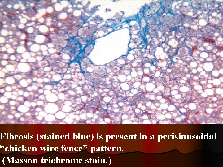 lecture-8-liver-diseases-cholestasis-cirrhosis-liver-normal