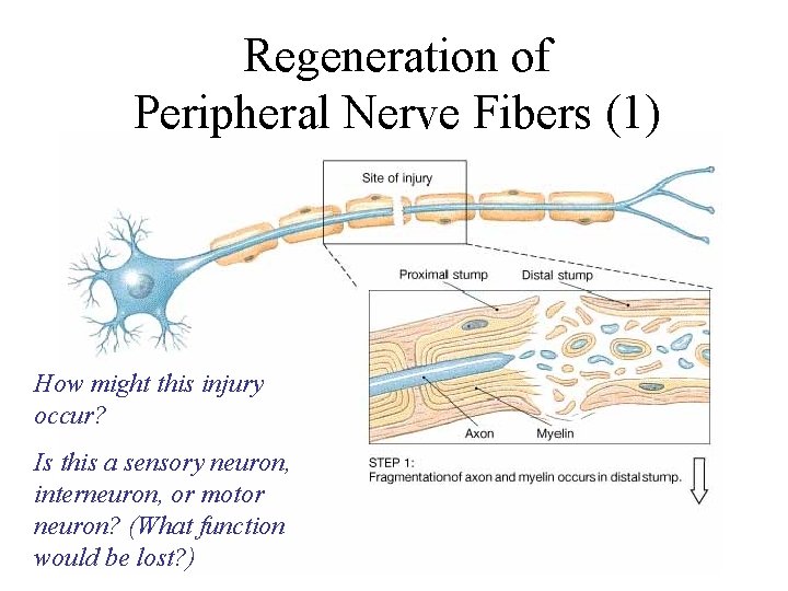 Regeneration of Peripheral Nerve Fibers (1) How might this injury occur? Is this a