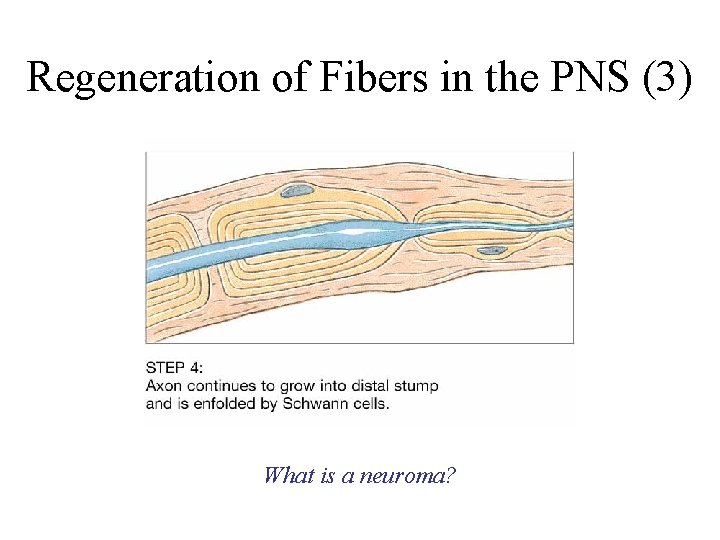 Regeneration of Fibers in the PNS (3) What is a neuroma? 