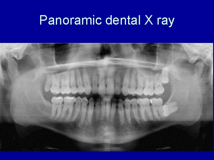 Panoramic dental X ray 