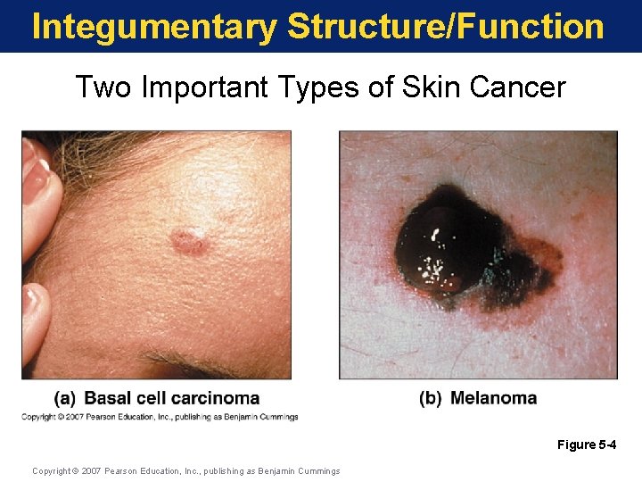 Integumentary Structure/Function Two Important Types of Skin Cancer Figure 5 -4 Copyright © 2007