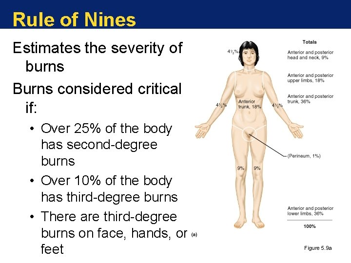 Rule of Nines Estimates the severity of burns Burns considered critical if: • Over