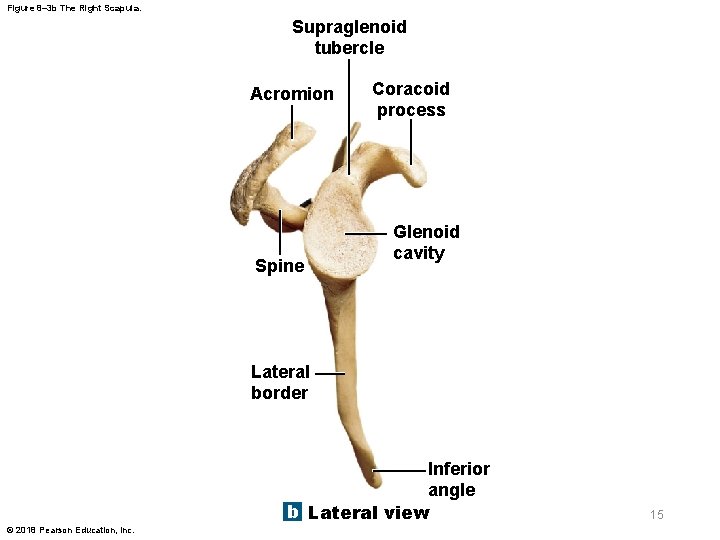 Figure 8– 3 b The Right Scapula. Supraglenoid tubercle Acromion Spine Coracoid process Glenoid