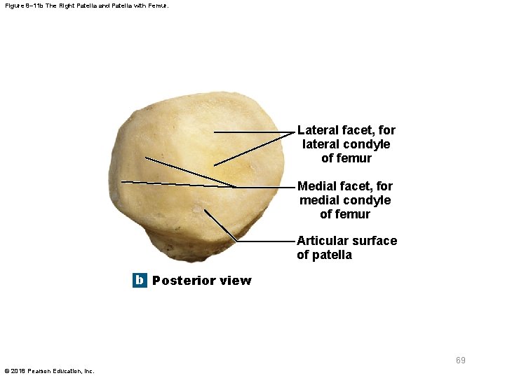 Figure 8– 11 b The Right Patella and Patella with Femur. Lateral facet, for