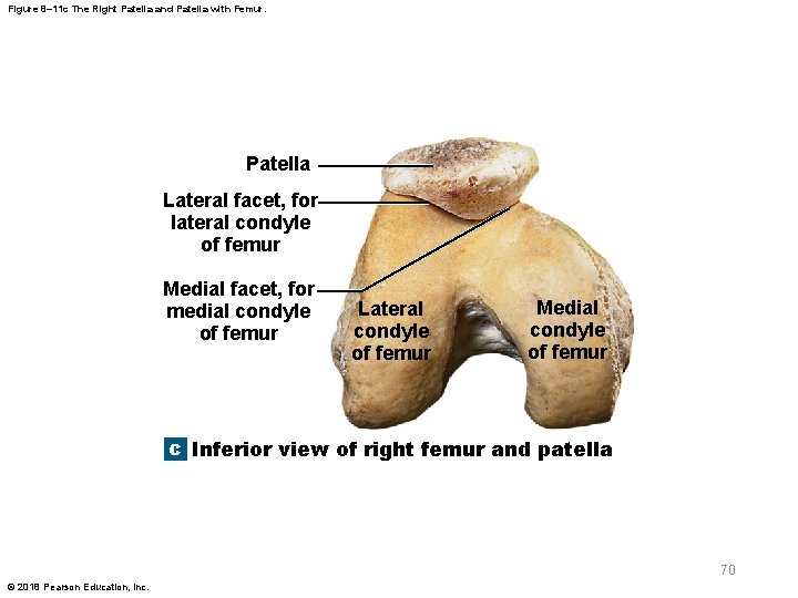 Figure 8– 11 c The Right Patella and Patella with Femur. Patella Lateral facet,