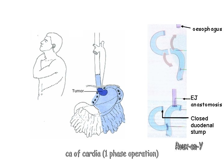 oesophagus EJ anastomosis Closed duodenal stump 