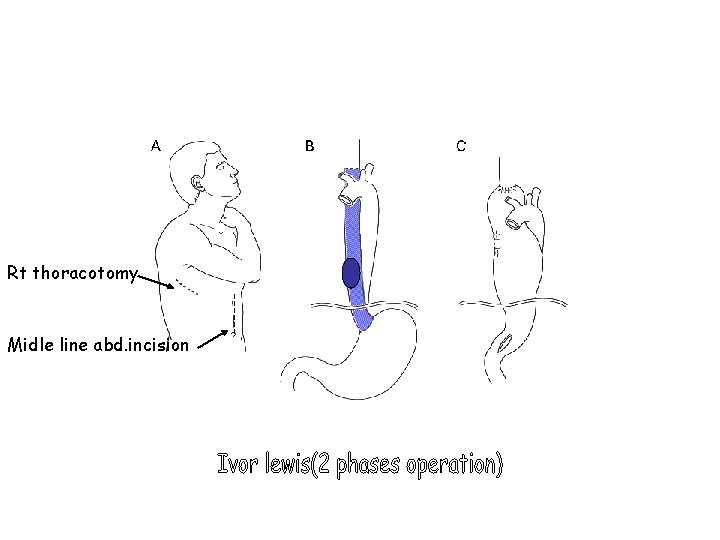 Rt thoracotomy Midle line abd. incision 