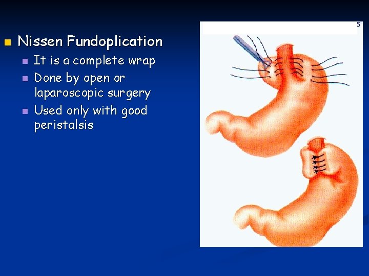 n Nissen Fundoplication n It is a complete wrap Done by open or laparoscopic