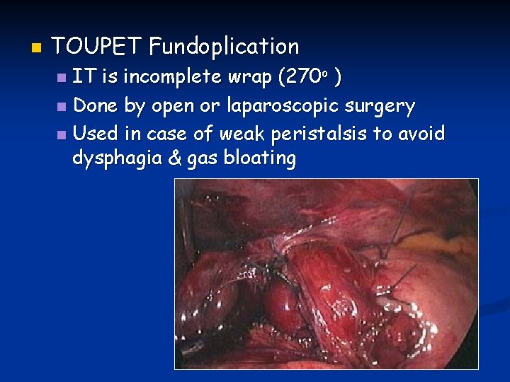 n TOUPET Fundoplication IT is incomplete wrap (270 o ) n Done by open