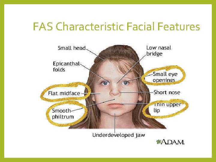 FAS Characteristic Facial Features 