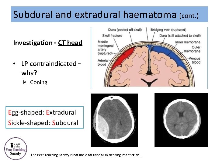 Subdural and extradural haematoma (cont. ) Investigation – CT head • LP contraindicated –