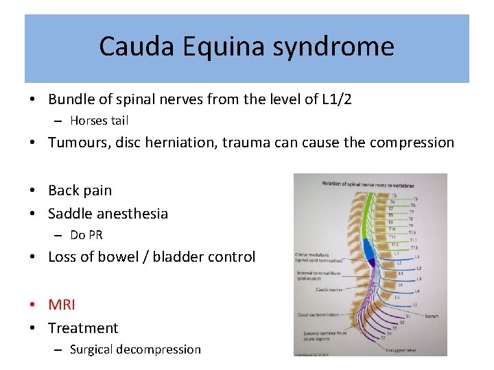 Cauda Equina syndrome • Bundle of spinal nerves from the level of L 1/2