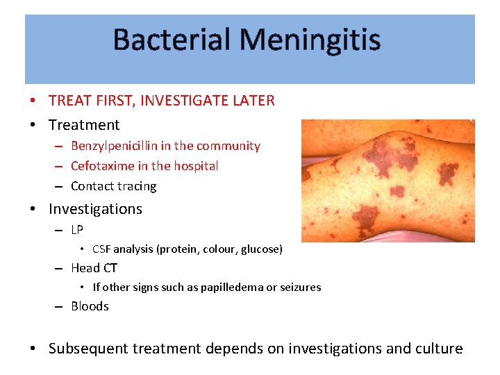 Bacterial Meningitis • TREAT FIRST, INVESTIGATE LATER • Treatment – Benzylpenicillin in the community