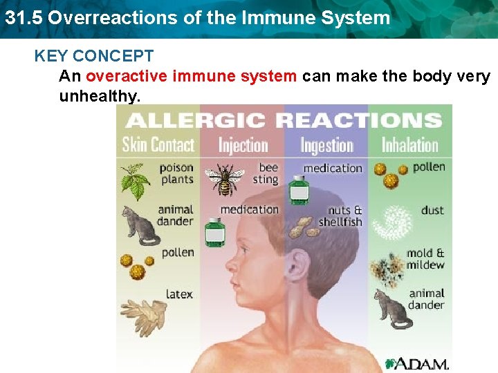 31. 5 Overreactions of the Immune System KEY CONCEPT An overactive immune system can