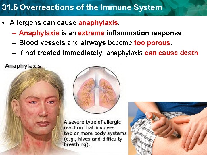 31. 5 Overreactions of the Immune System • Allergens can cause anaphylaxis. – Anaphylaxis