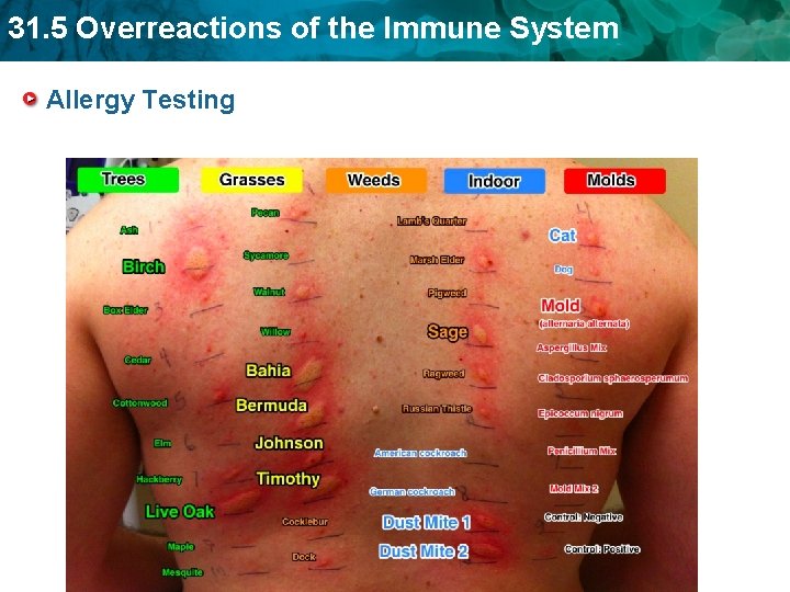 31. 5 Overreactions of the Immune System Allergy Testing 