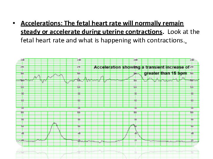  • Accelerations: The fetal heart rate will normally remain steady or accelerate during