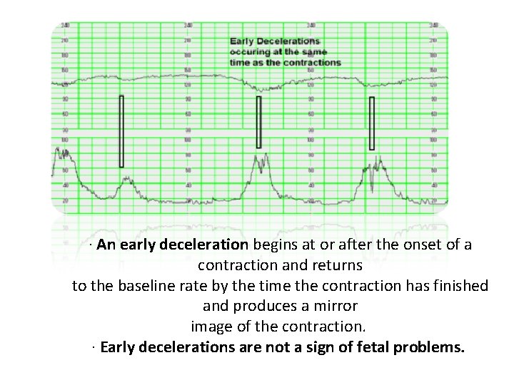 · An early deceleration begins at or after the onset of a contraction and