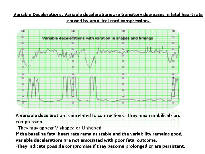 Variable Decelerations: Variable decelerations are transitory decreases in fetal heart rate caused by umbilical